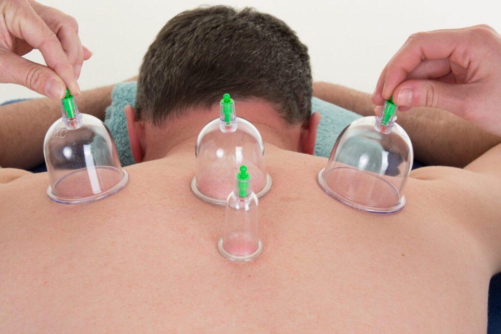 A cupping expert performing dry cupping.